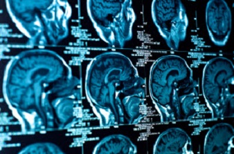 Neurorradiología Intervencionista Neurorradiología Intervencionista