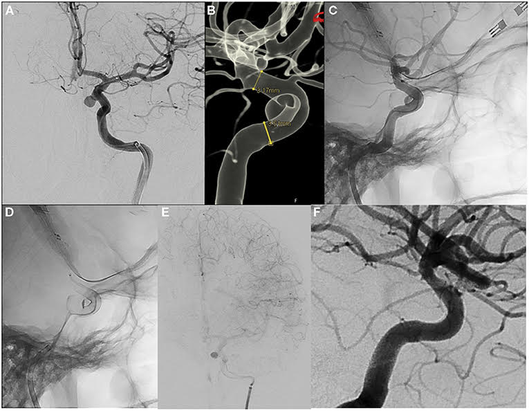 Tratamiento de aneurismas intracraneales con el nuevo Flow Diverter Silk Vista: seguridad con resultados de seguimiento a corto plazo.