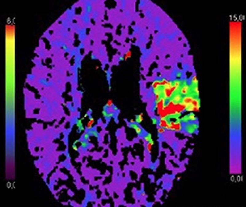 Experiencia inicial realizando una trombectomía mecánica con el dispositivo CatchView mini para oclusiones de la arteria cerebral media del segmento M2 distal