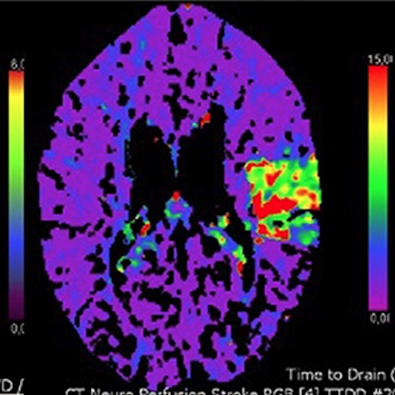 Experiencia inicial realizando una trombectomía mecánica con el dispositivo CatchView mini para oclusiones de la arteria cerebral media del segmento M2 distal